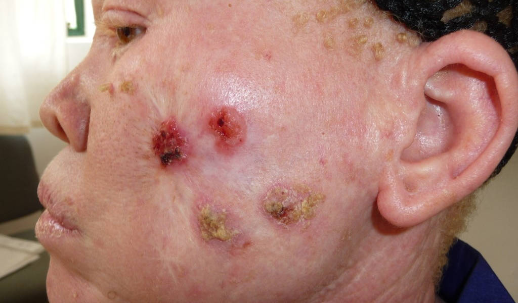 Cancer de la peau, une épidémie causée par le soleil