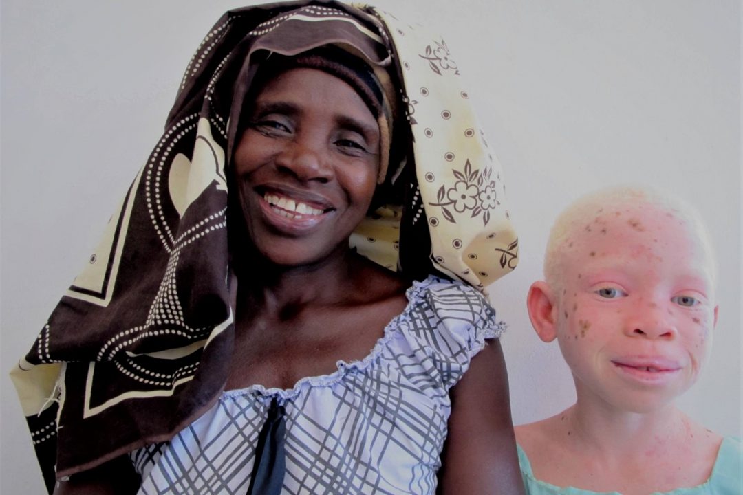 ¿Por qué hay más personas con albinismo en África que en Europa?