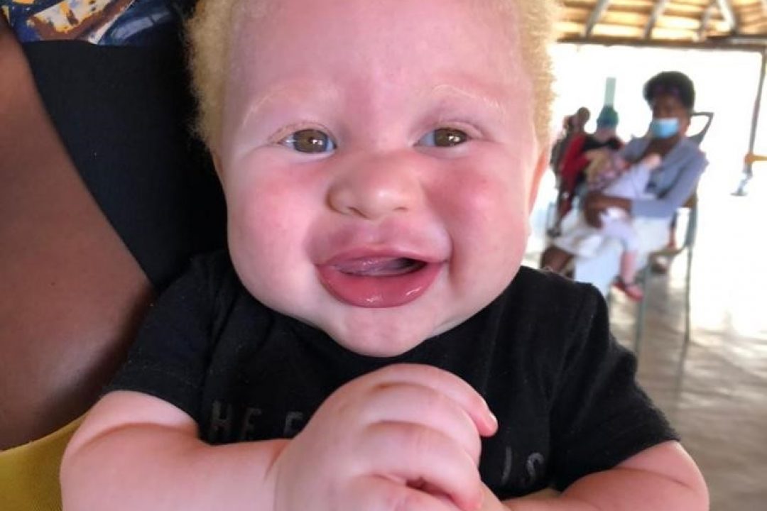 Albinismo en Angola: Un nuevo paso hacia la sensibilización