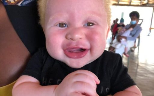 Albinismo en Angola: Un nuevo paso hacia la sensibilización