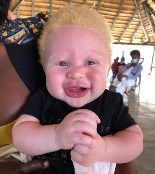 Albinismo en Angola: Un nuevo paso hacia la sensibilización