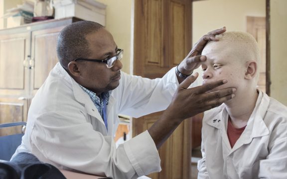 10 cosas que quizás no sabías sobre el albinismo