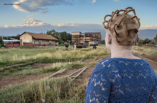 Día Internacional de Sensibilización sobre el Albinismo