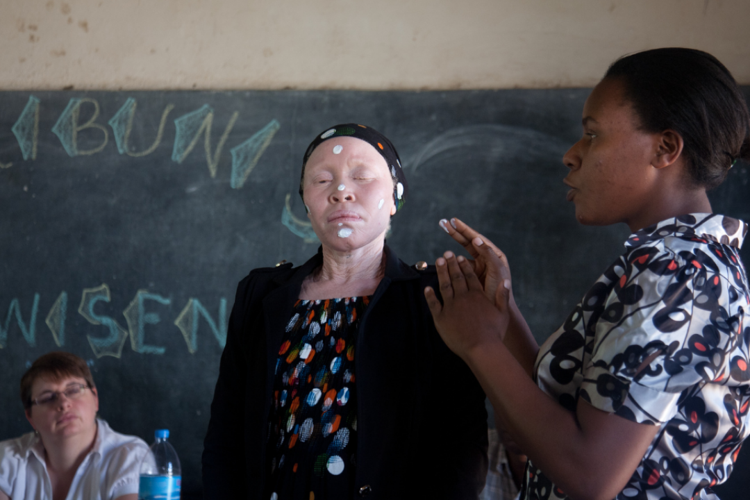 ¿Por qué no cualquier protector solar sirve para el albinismo?