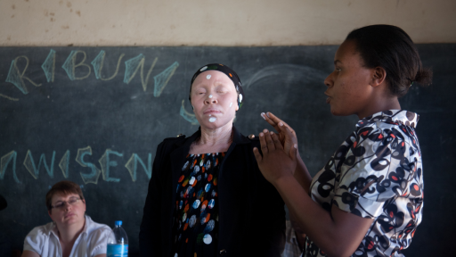 ¿Por qué no cualquier protector solar sirve para el albinismo?