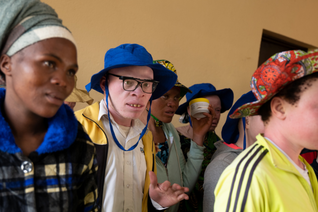 ¿Por qué la piel sin melanina sufre más?