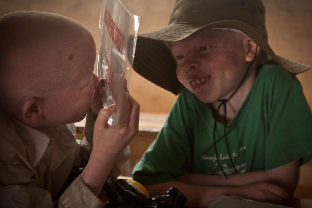 Visión y albinismo: un reto silencioso que impacta en la educación de los niños