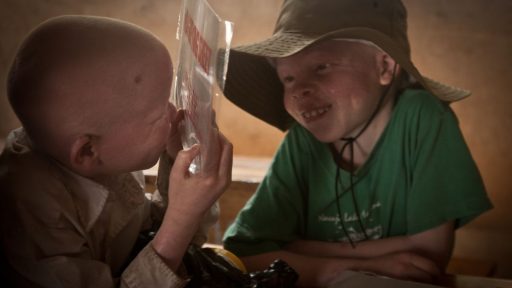 Visión y albinismo: un reto silencioso que impacta en la educación de los niños