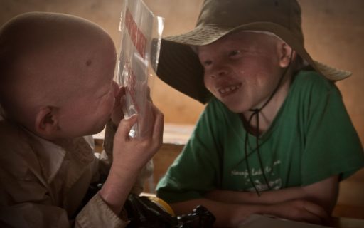 Visión y albinismo: un reto silencioso que impacta en la educación de los niños